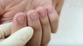 tirnak-yiyen-tedavisi-5